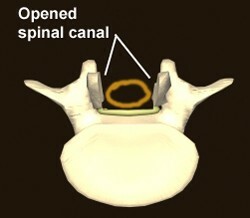 postoperatief na verwijderen van het spinale kanaal