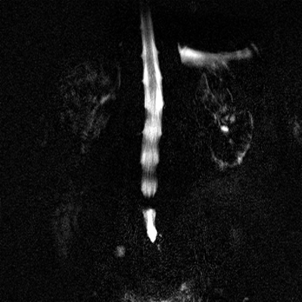 nmr myelogram met stopbeeld zwarte vlek